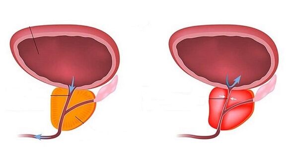 Healthy and inflamed prostate (with prostatitis)