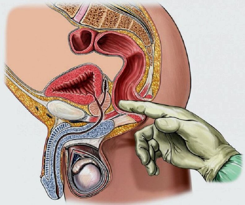 Prostate massage to treat prostatitis